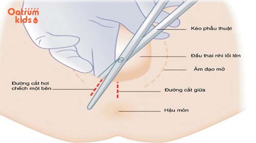  Rạch tầng sinh môn giúp em bé chào đời dễ dàng hơn.