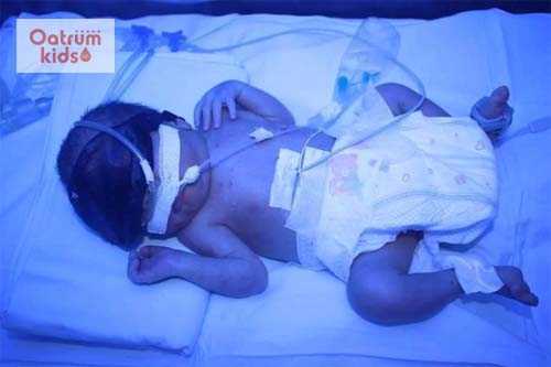  Trẻ sơ sinh bị suy hô hấp cần được chăm sóc đặc biệt trong lồng ấp