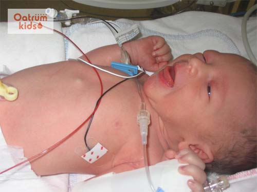  Suy hô hấp ở trẻ sơ sinh là bệnh lý nguy hiểm