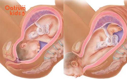  Chuyển dạ là giai đoạn đầu của quá trình sinh con.