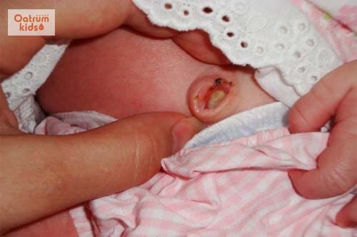  Dấu hiệu bất thường ở rốn trẻ sơ sinh: sưng tấy, có dịch vàng