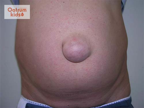  Dấu hiệu bất thường ở rốn trẻ sơ sinh: Rốn lồi do bị thoát vị