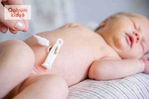  Viêm rốn ở trẻ sơ sinh