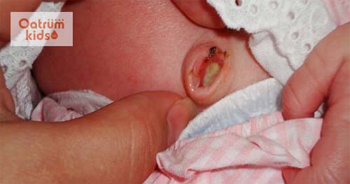   Rốn trẻ sơ sinh có mùi hôi, chảy dịch