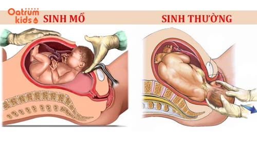 Hình thức mổ đẻ mang đến lợi ích cũng như những lưu ý cho mẹ khi chọn