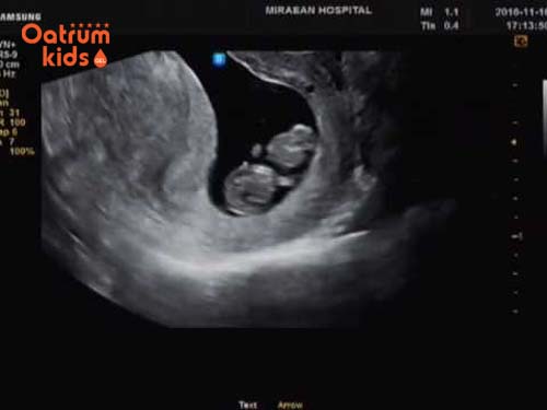 Thai được 9 tuần tuổi đã biết cử động chân tay, đặt tay lên ngực.