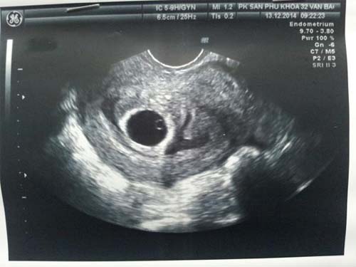 Thai 6 tuần đã có tim thai và tim đã bắt đầu hoạt động.