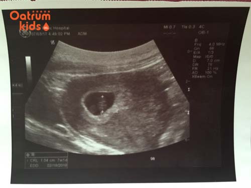  Thai 7 tuần tuổi chưa thể siêu âm được giới tính.