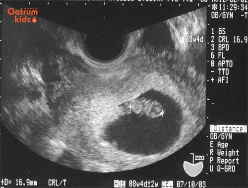  Kích thước của thai 8 tuần tuổi đã như một quả nho Mỹ.