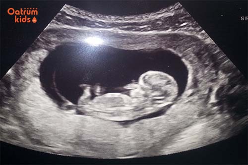 Thai nhi 11 tuần tuổi đã biết đá chân, đạp, xoay mình và trườn.