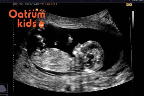 Thai nhi tuần thứ 12 đã có thể chẩn đoán được giới tính.