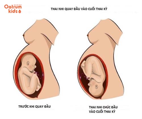 Thai quay đầu sớm sẽ làm tăng khả năng sinh non.