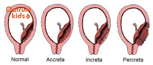  Các dạng nhau cài răng lược khác nhau từ nhẹ đến nặng.