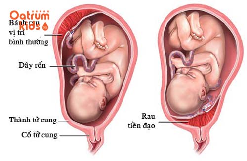  Nhau cài răng lược là tình trạng gai nhau bám sâu vào tử cung.