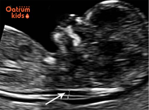 Khoảng sáng sau gáy thai nhi