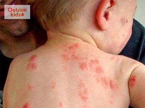  Trẻ sơ sinh có thể bị zona thần kinh