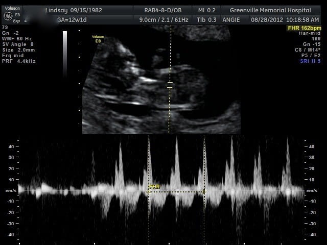 Mẹ có thể nghe được nhịp đập tim thai khi bé được 9 tuần trở lên.