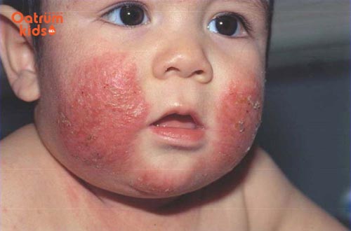 Bé bị chàm sữa gây nổi mụn đỏ ngứa ngáy ở hai má