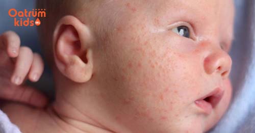 Nhiều trẻ bị mẩn đỏ ở má vì thời tiết