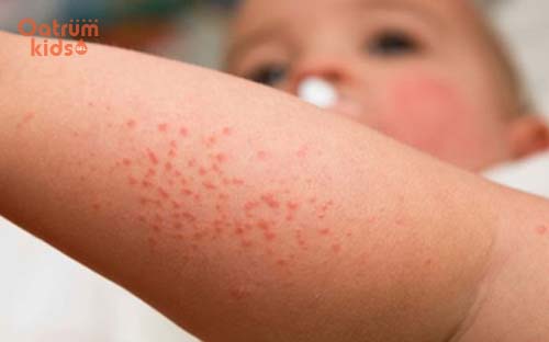 Mắc rôm sảy cũng là lí do khiến trẻ bị mẩn ngứa