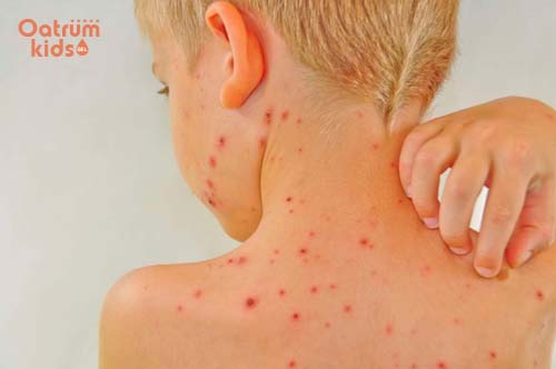 Tuyệt đối không để trẻ cào gãi lên vùng da bị mẩn đỏ