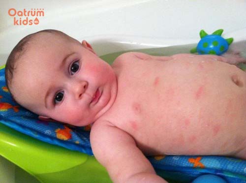 Mẩn ngứa ở trẻ có thể do nhiều nguyên nhân