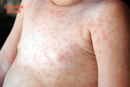 Trẻ nổi mề đay do di truyền, thời tiết, thực phẩm hoặc tiếp xúc với vật lạ