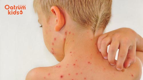 Thời tiết thay đổi dễ khiến trẻ nổi mẩn ngứa