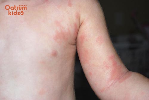 Bé sơ sinh bị mẩn đỏ nên tắm các loại lá theo kinh nghiệm dân gian