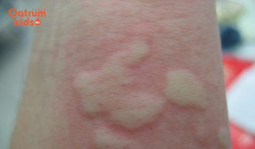 Da nổi mẩn đỏ là triệu chứng ban đầu của bệnh mề đay