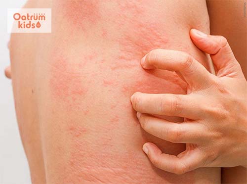 Gãi có thể tăng nguy cơ tổn thương da do mề đay