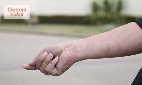 Bị mề đay kiêng gió nhưng không nhất thiết phải che chắn quá kỹ