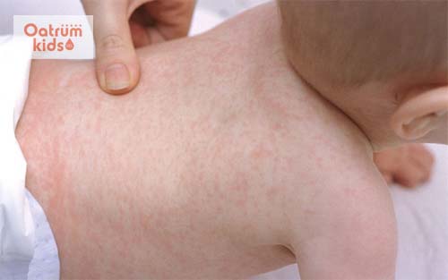 Có rất nhiều nguyên nhân nổi mề đay thông thường ở trẻ