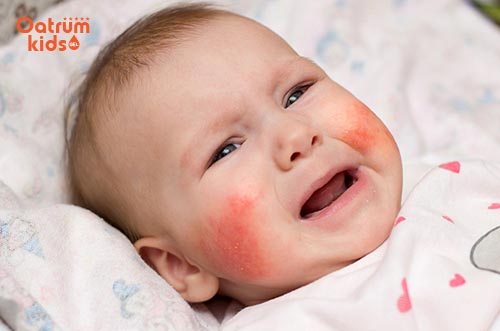 Da bé nổi hồng ban, sờ khô ráp, ngứa ngáy là những biểu hiện cụ thể của bệnh