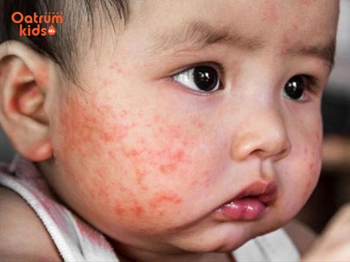 Viêm da cơ địa ở trẻ em hay còn gọi là chàm sữa rất phổ biến và khó chữa