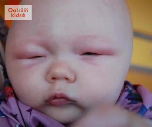 Biến chứng phù mạch do mề đay cấp tính gây ra