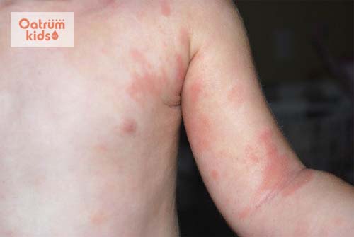 Triệu chứng nổi mề đay cấp ở trẻ là xuất hiện mẩn đỏ, ngứa trên da