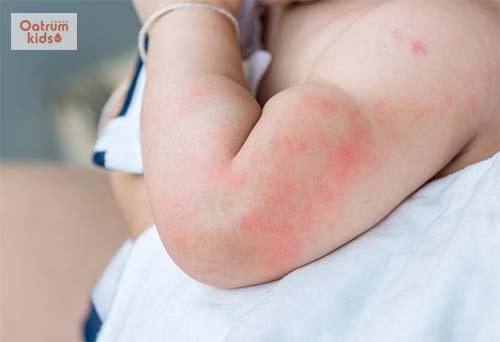  Thời tiết chuyển sang nóng hoặc lạnh, hanh khô rất dễ gây nổi mề đay cho trẻ