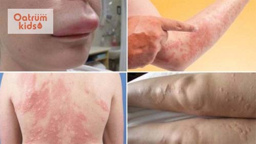  Biến chứng dị ứng thời tiết nổi mề đay là phù mạch, sốc phản vệ, nhiễm trùng…