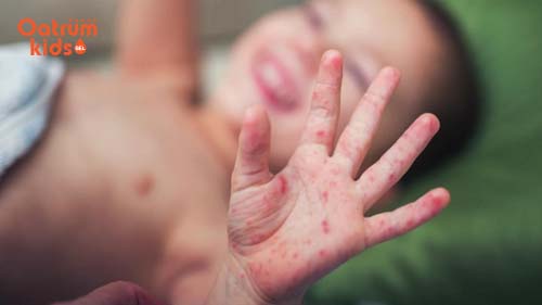 Mẩn ngứa nhiều khiến nhiều trẻ bị sụt cân nghiêm trọng