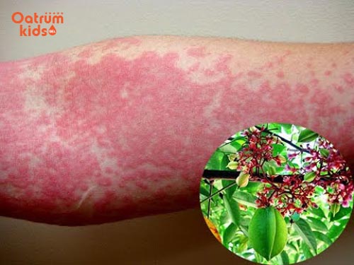 Trị mề đay bằng phương pháp dân gian