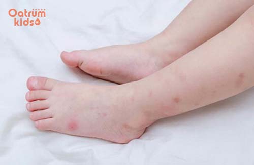 Mẩn ngứa khiến trẻ vô cùng khó chịu