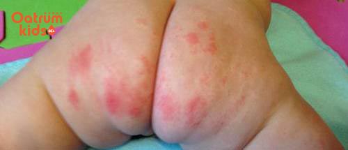 Trẻ sơ sinh nổi mẩn đỏ ở mông là dấu hiệu của bệnh lý hăm tã