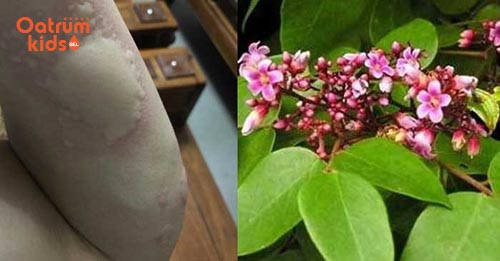 bài thuốc trị mề đay cho trẻ từ lá khế