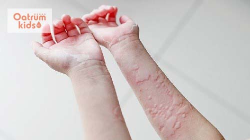  Bệnh mề đay biểu hiện bằng các nốt sẩn, phù nề màu hồng hoặc đỏ.