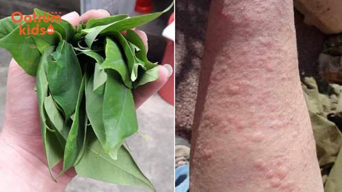 Lá khế có tác dụng phong nhiệt, giải độc, lợi tiểu nên rất hiệu quả với trẻ bị nổi mề đay