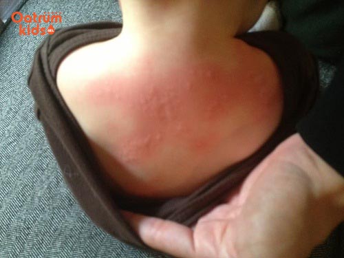 Trẻ bị nổi mề đay gây sưng đỏ, ngứa ngáy