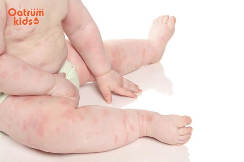Bé bị nổi mề đay khắp người thường do thời tiết hoặc dị ứng thức ăn