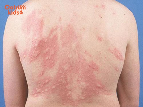 Triệu chứng nổi mề đay ở trẻ có thể quan sát bằng mắt thường