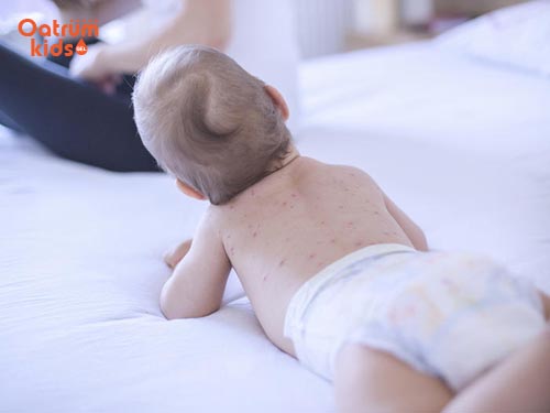 cách chữa mề đay ở trẻ em-Trước khi điều trị hãy tìm ra nguyên nhân khiến trẻ nổi mề đay